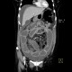 Carcinoma of transverse colon, ileus, perforation of bowel, peritonitis: CT - Computed tomography
